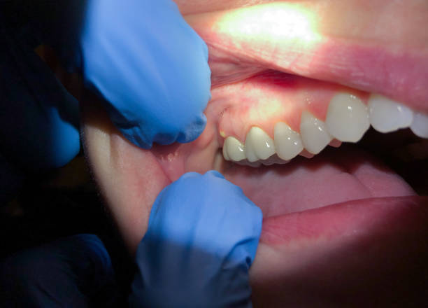 Best Emergency Dental Care for Broken or Chipped Teeth in Rockford, MI