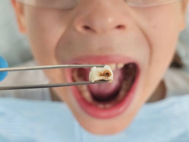 Best Emergency Dental Care for Broken or Chipped Teeth in Rockford, MI